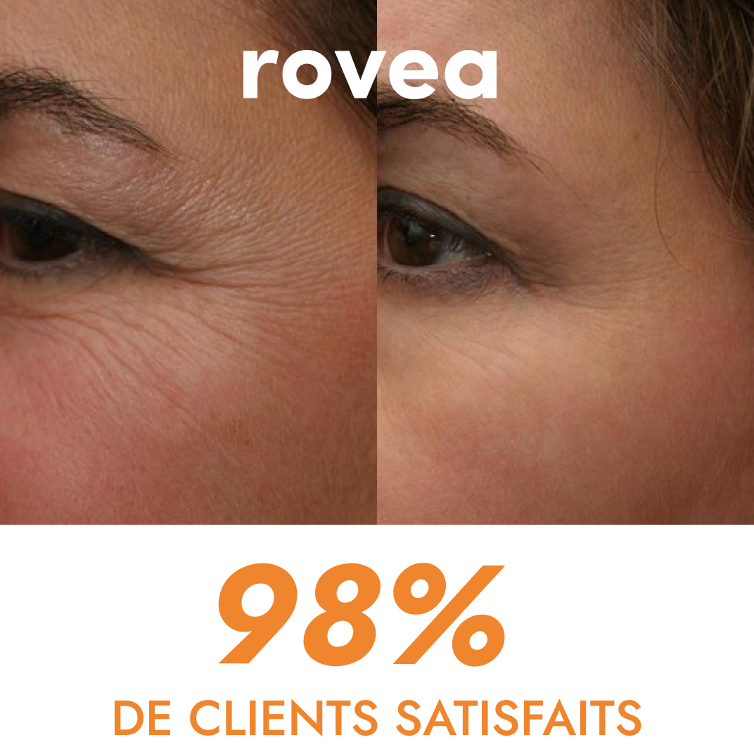 Invisible Korean Collagen Face Mask (Cheeks and Forehead)