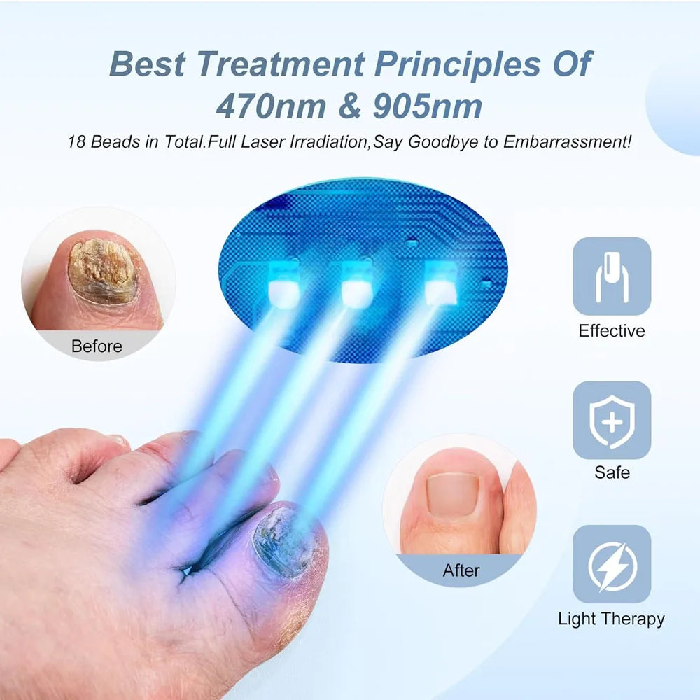 LaserNail Pro – Anti-Fungal Nail Treatment Device