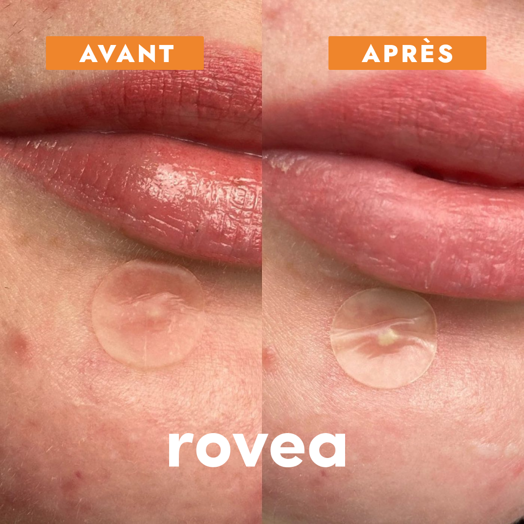 Anti Pimples and Acne Patches