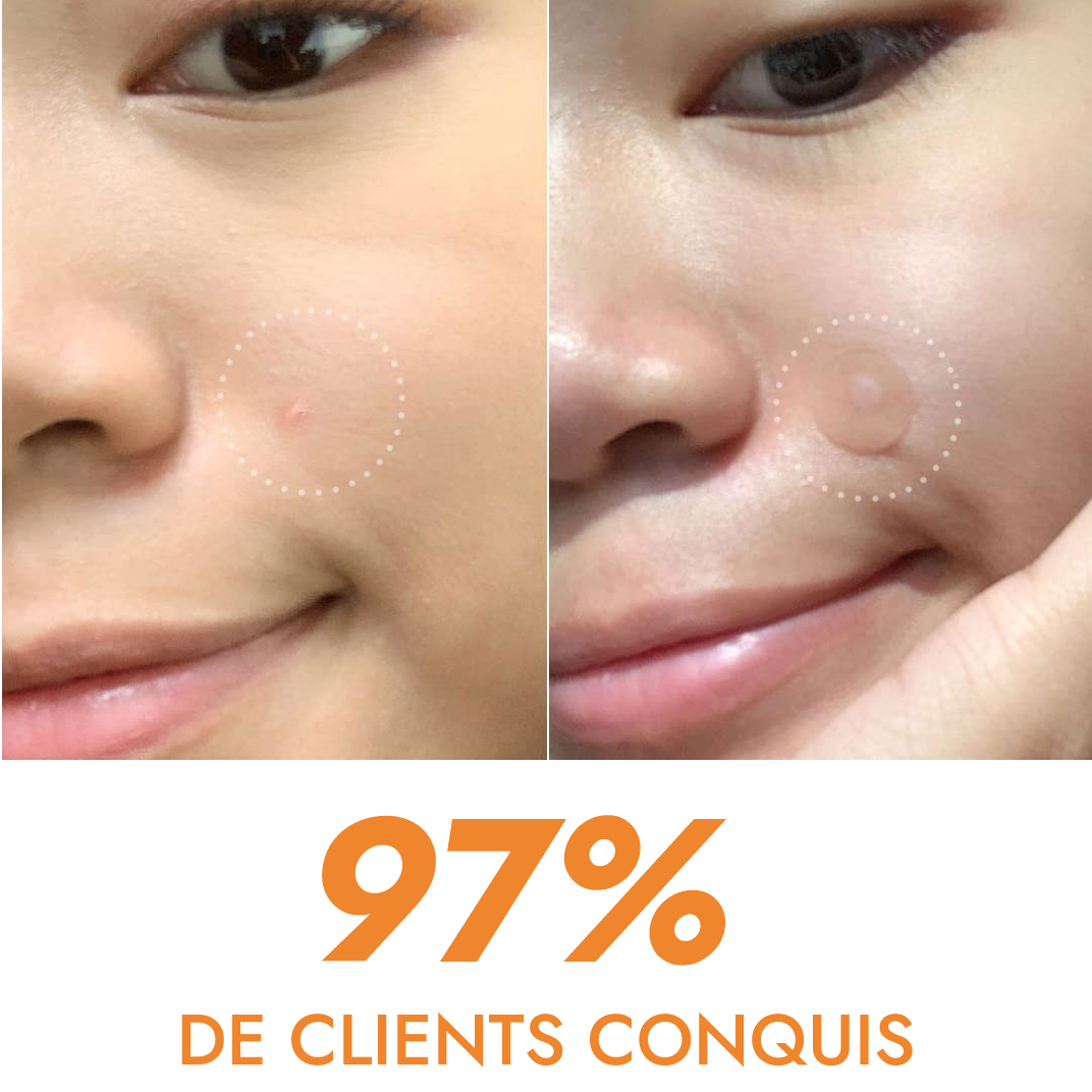 Anti Pimples and Acne Patches